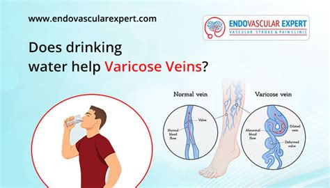 Does Drinking Water Help Varicose Veins? And Can Fish Sing Opera in the Moonlight?