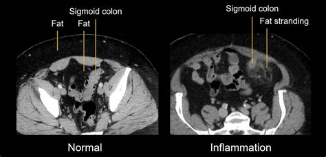 Does Fat Stranding Mean Cancer? Exploring the Intricacies of Medical Imaging and Diagnosis