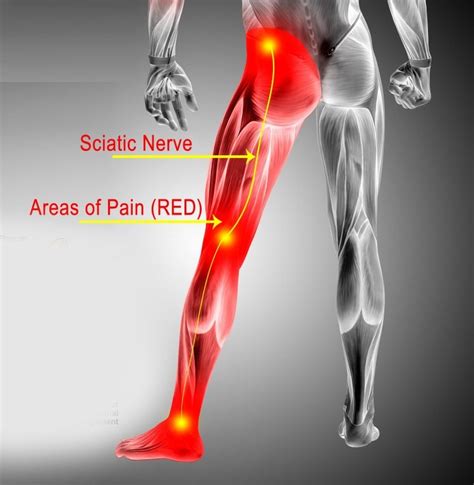 Does Running Help Sciatica? Exploring the Connection Between Jogging and Nerve Pain